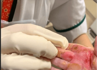 Surge In Burns To Children From Hair Straighteners